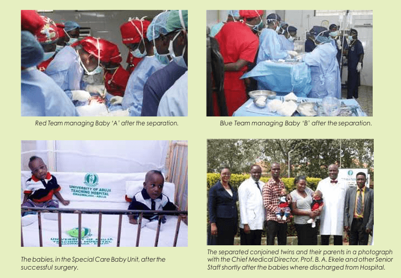 Red and Blue teams in theatre, Special Care Baby Unit, and the separated twins with their parents and UATH senior staff after discharge