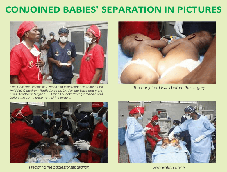 Conjoined babies' separation in pictures: surgical team, twins before surgery, preparation, and separation done